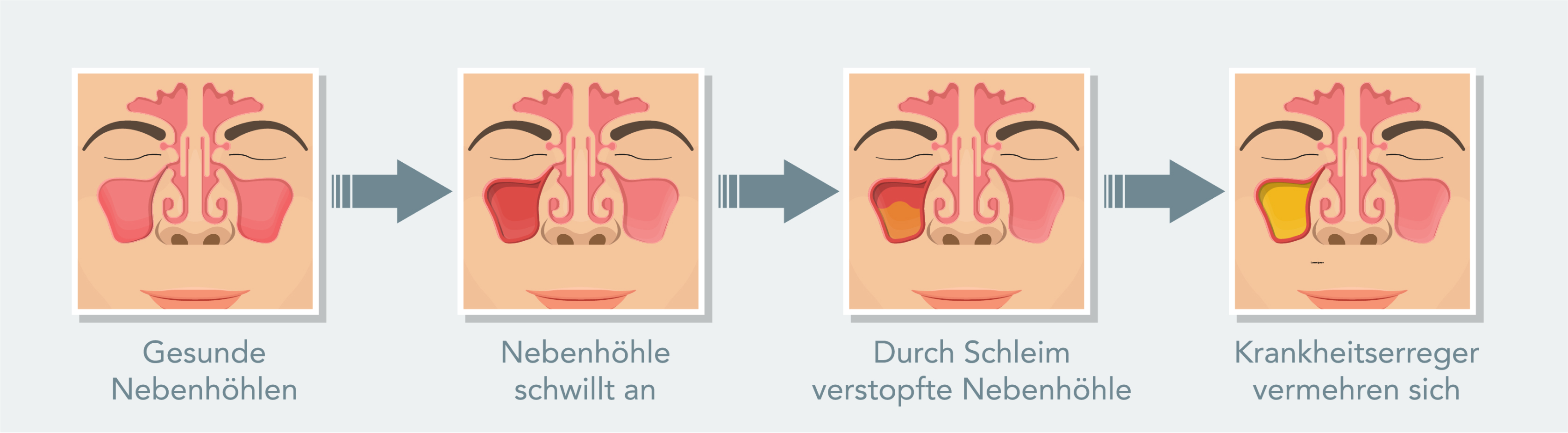 Nasennebenhöhlenentzündung (Sinusitis) - Wie gestaltet sich der Verlauf einer Nasennebenhöhlenentzündung?