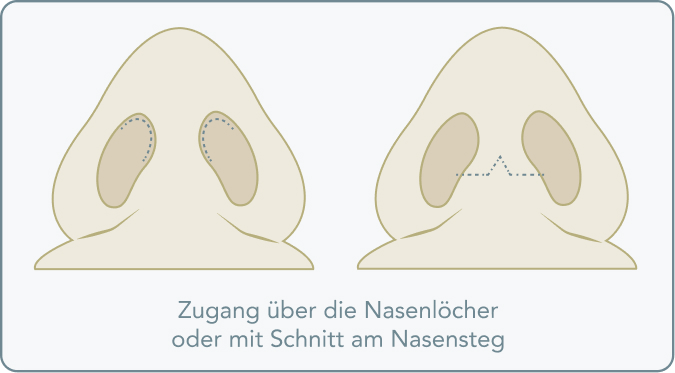 Nasenspitzenkorrektur - Wie funktioniert die Nasenspitzenkorrektur?