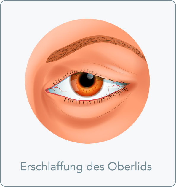 Schlupflider entfernen - Was sind Schlupflider?