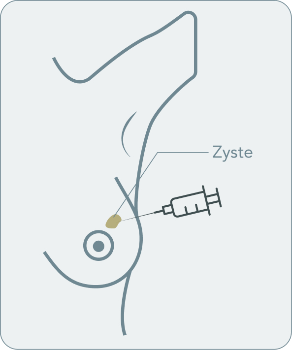 Mastodynie - Wie wird eine Mastodynie behandelt?