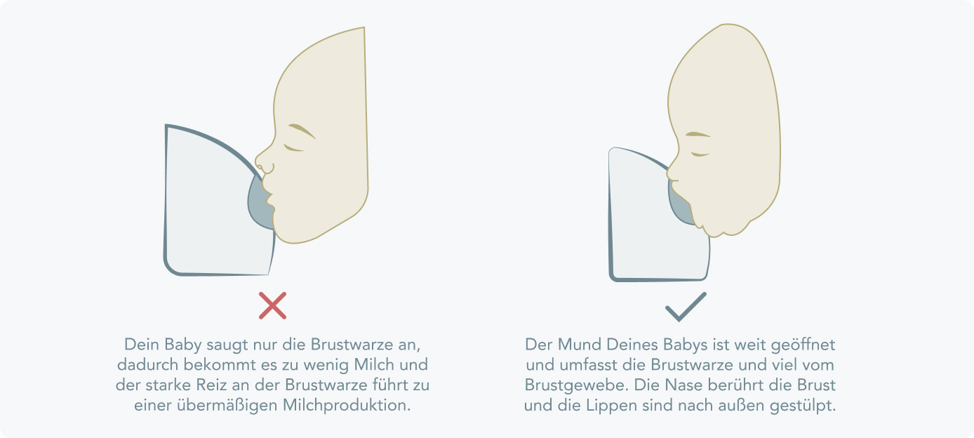 Milchstau - Baby stillen