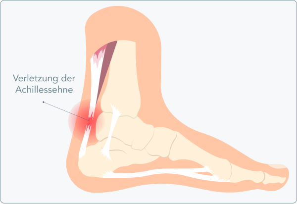 Achillodynie - Was ist der Unterschied zwischen Achillodynie und Achillessehnenentzündung?