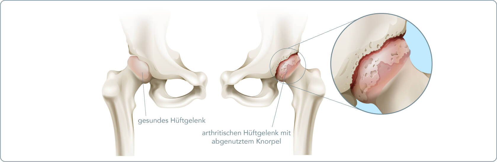 Arthritis - Arthritis Symptome im Gelenk der großen Zehe
