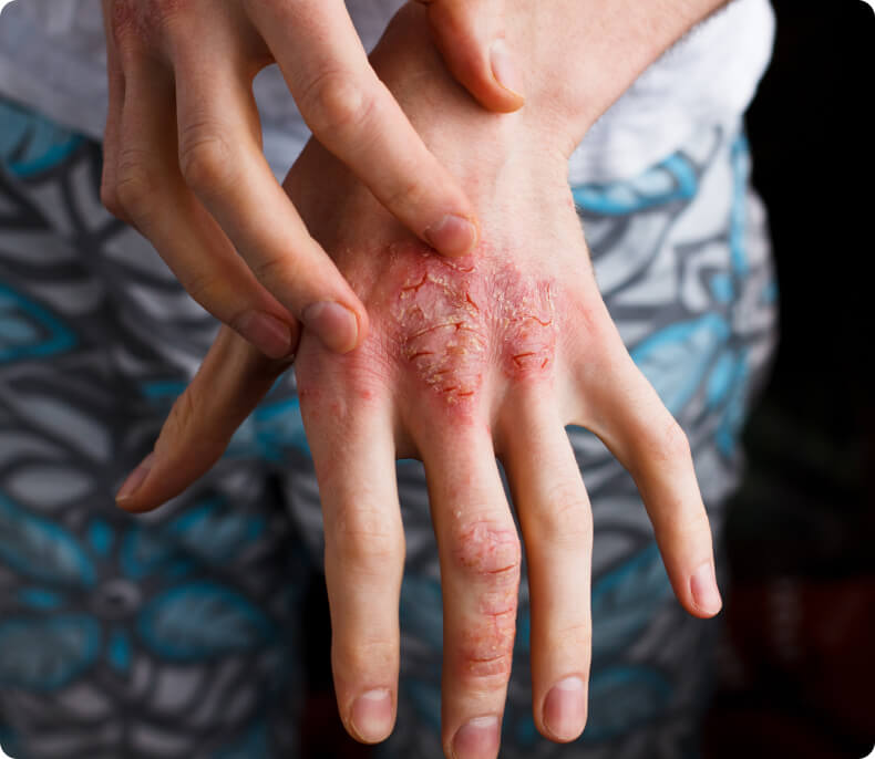 Arthritis - Welche Ursachen hat eine Arthritis?