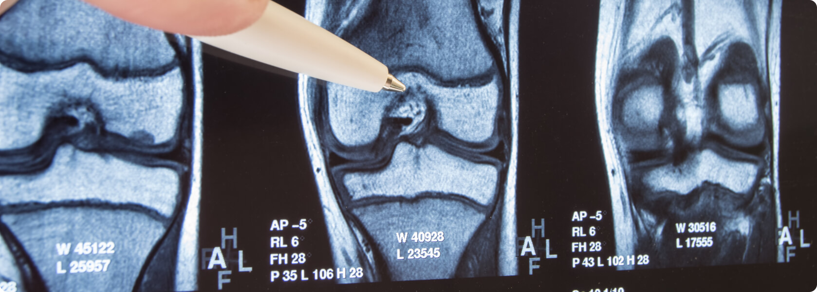 Arthrose - Offen chirurgische Methoden