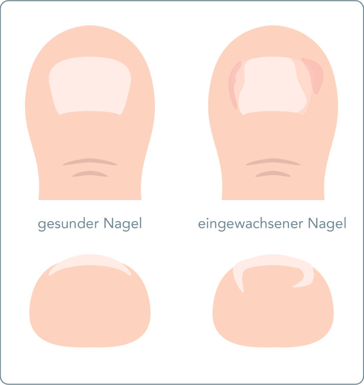 Eingewachsener Zehennagel - Phlegmone