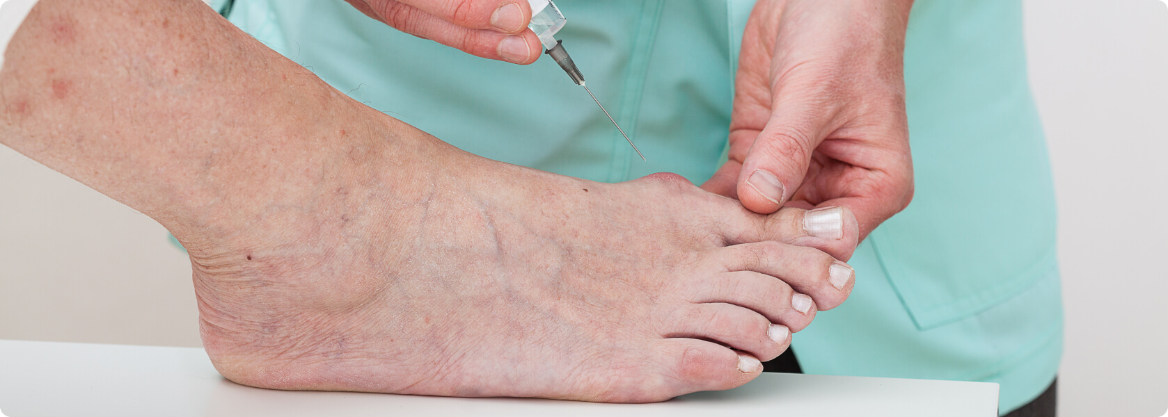 Hallux rigidus - Arthrose