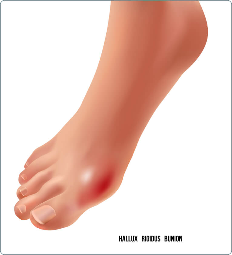 Hallux rigidus - können sich manchmal kleine Gelenkkörper lösen