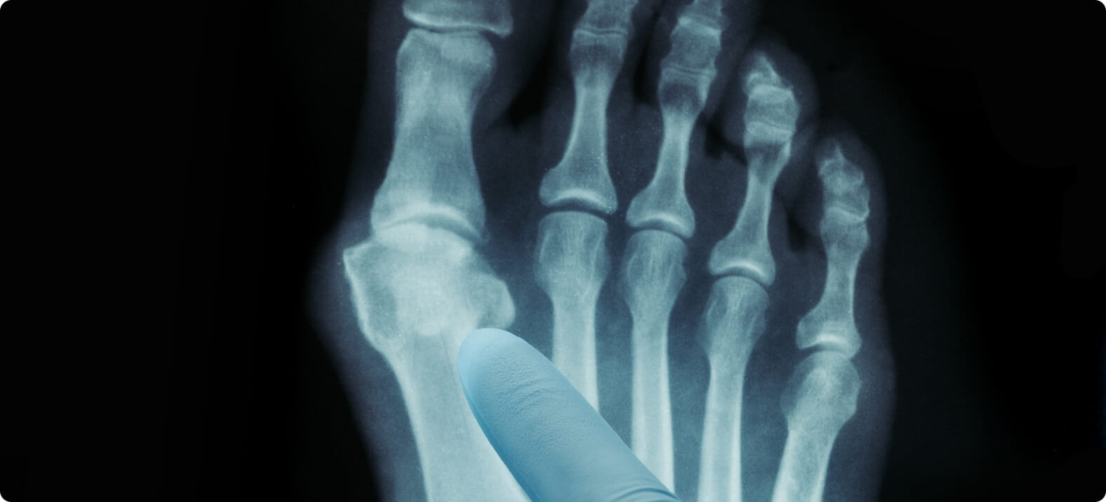 Hallux rigidus - Magnetresonanztomographie (MRT)