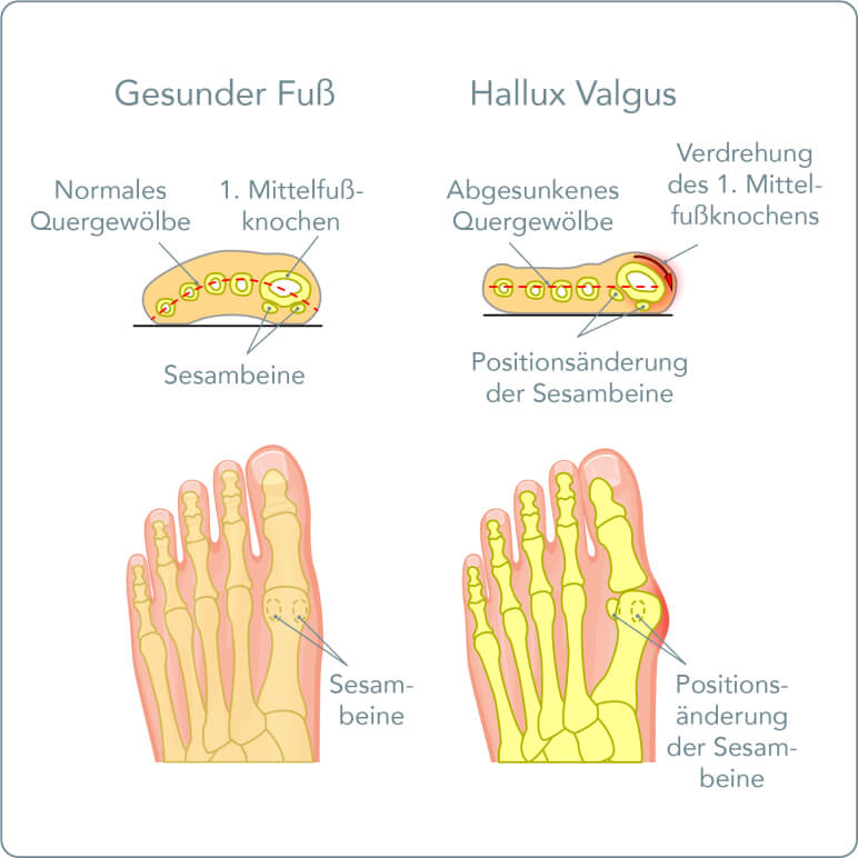 Hallux rigidus - Was ist der Unterschied zwischen einem Hallux rigidus und einem Hallux valgus?