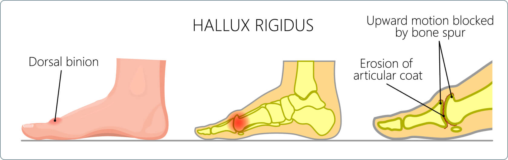 Hallux rigidus - Welche Stadien von Hallux rigidus gibt es?