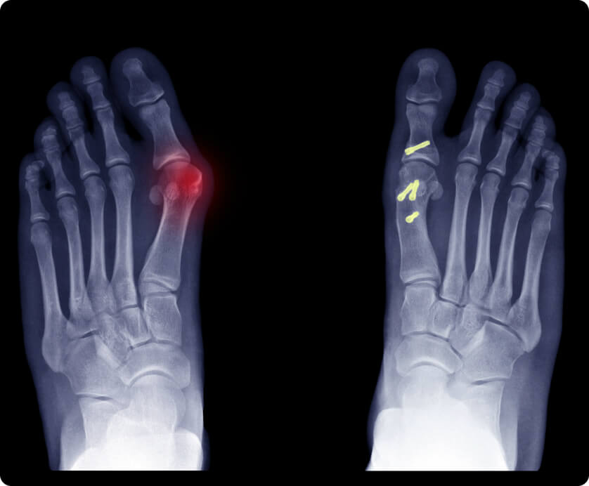 Hallux valgus - Verbindung zwischen Fußwurzel- und Mittelfußknochen