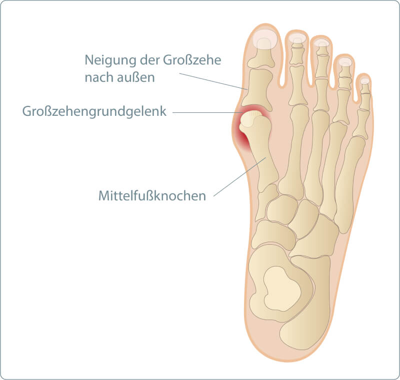 Hallux valgus - nach außen geneigte Großzehe