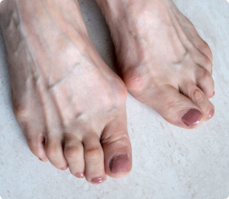 Hallux valgus - Was ist der Unterschied zwischen einem Hallux valgus und einem Hallux rigidus?
