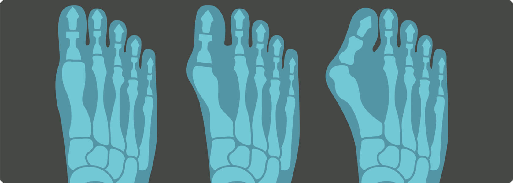 Hallux valgus - Wie lässt sich ein Hallux valgus behandeln?