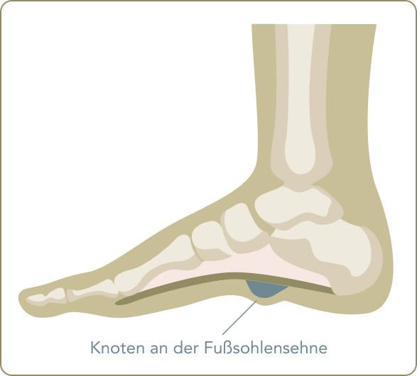 Morbus Ledderhose - Welche Grade von Morbus Ledderhose gibt es?