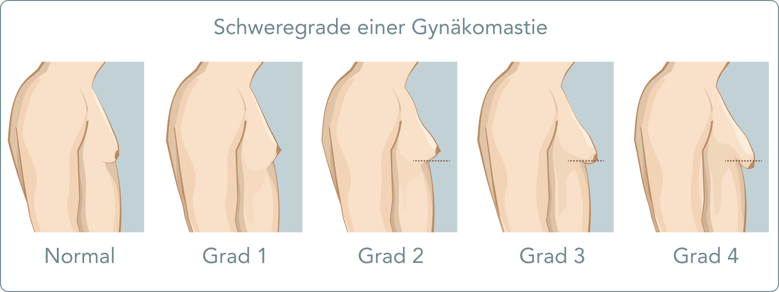 Gynäkomastie - Wie entwickelt sich eine Gynäkomastie?