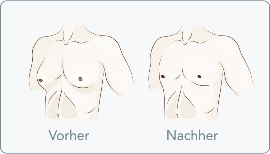 Gynäkomastie - Wie verläuft die Brust-OP bei einer Gynäkomastie?