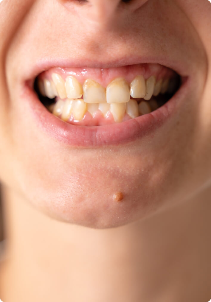 Aligner - Risiko für Karies und Parodontitis