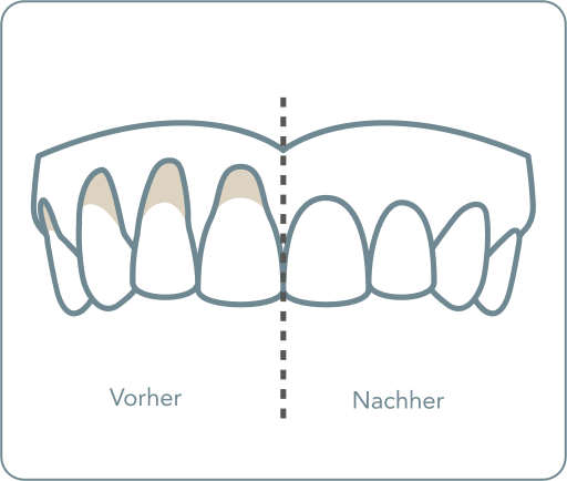Zahnfleischtransplantation - Wie läuft eine Zahnfleischtransplantation ab?