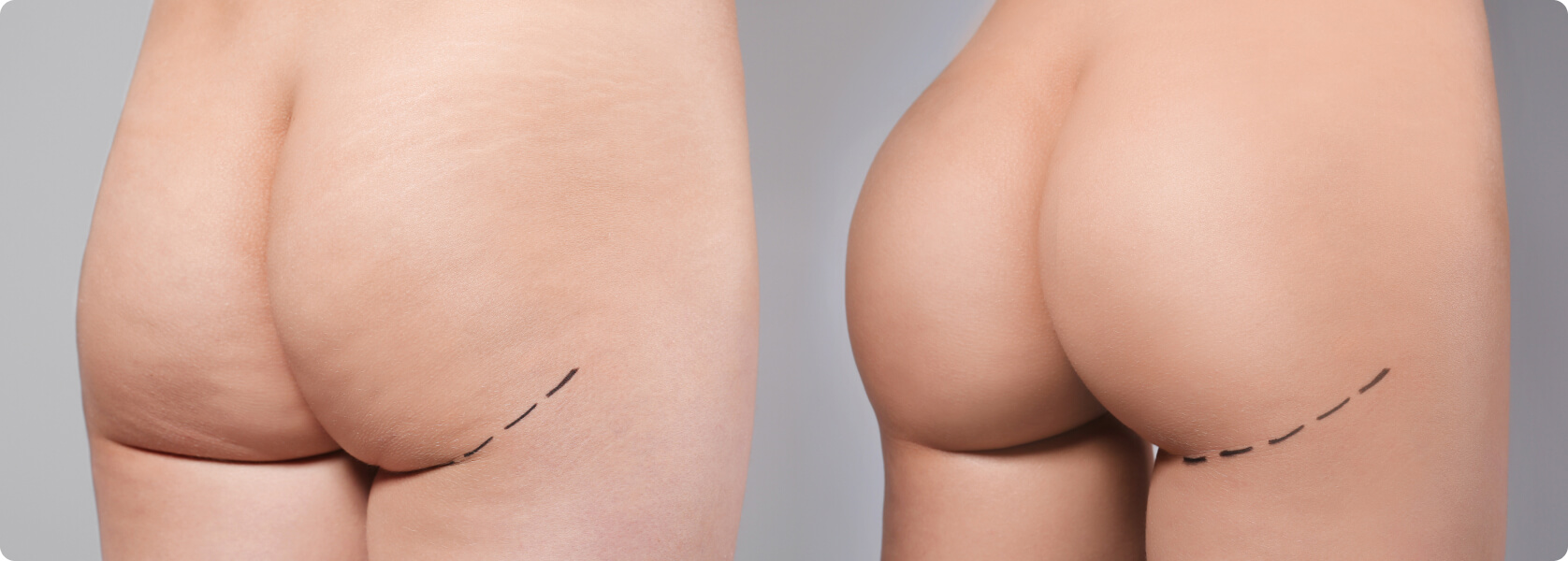 Brazilian Butt Lift - Wie läuft ein Brazilian Butt Lift ab?