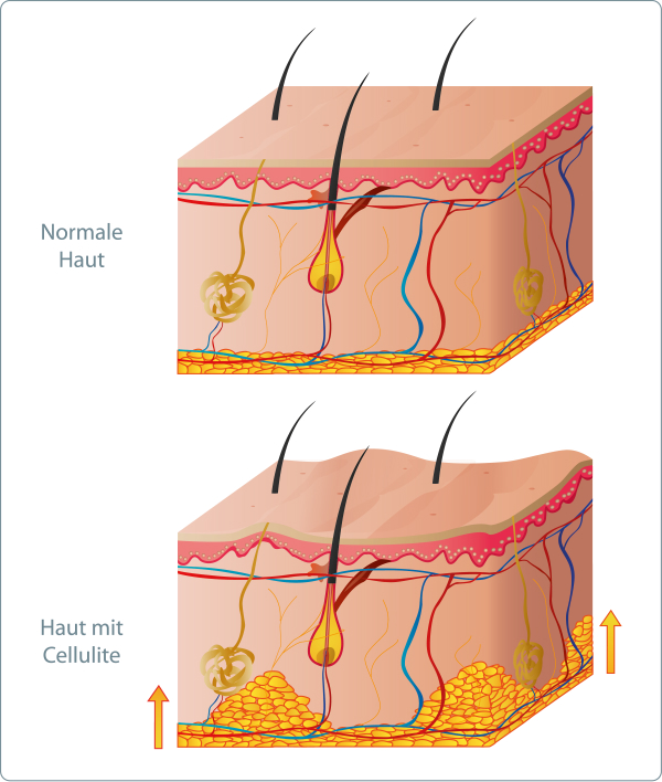 Cellulite - Welche Rolle spielt das Bindegewebe bei Cellulite?