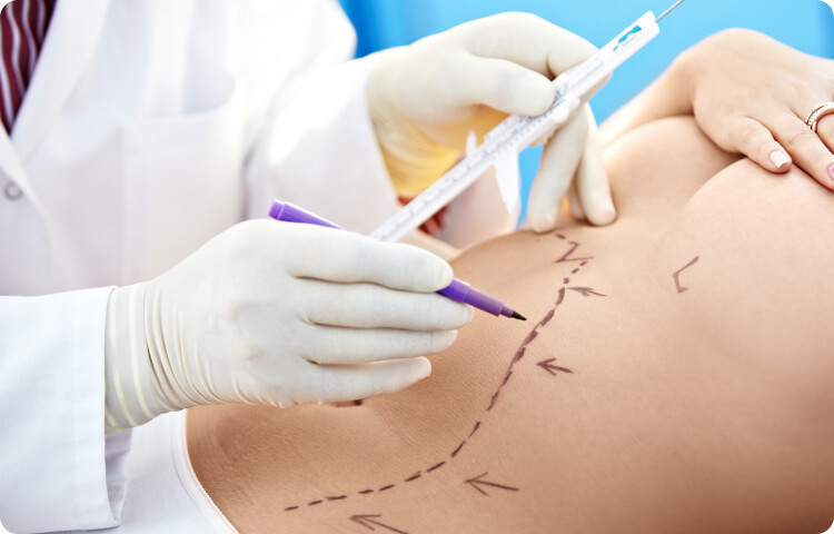Fettabsaugung (Liposuktion) - Mit welchen Verfahren lässt sich eine Fettabsaugung kombinieren?