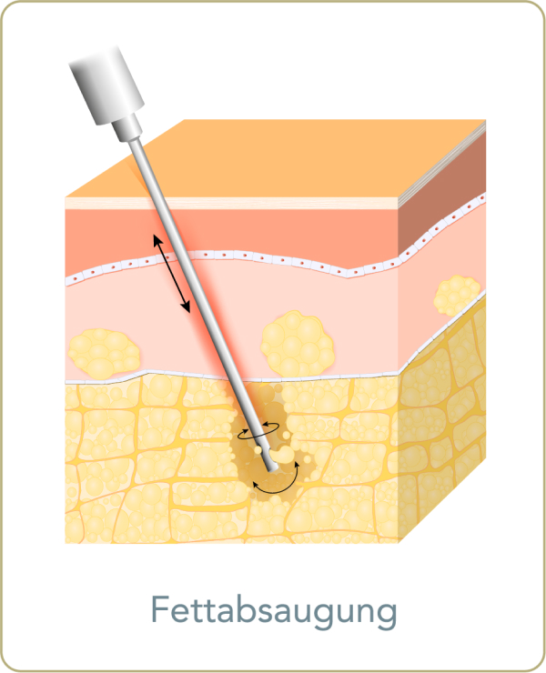 Fettabsaugung (Liposuktion) - Wie funktioniert eine Liposuktion mit der Tumeszens-Methode?