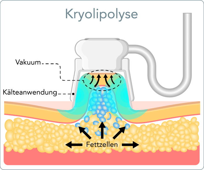 Kryolipolyse - Wie funktioniert die Kryolipolyse?