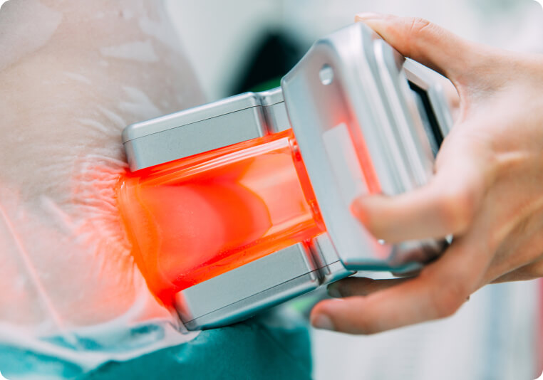 kryolipolyse - Wie läuft eine Behandlung mittels Kryolipolyse ab?