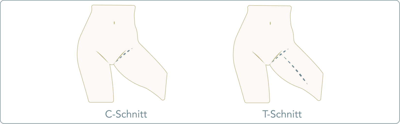 Oberschenkelstraffung - Ein-Schnitt-Technik (C-Schnitt)