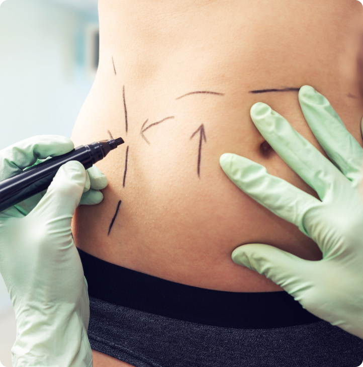 Vaser Lipo - Wie läuft eine Vaser Lipo ab?