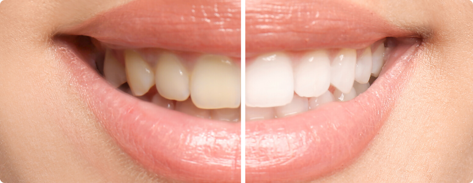 Bleaching (Zahnaufhellung) - Home Bleaching