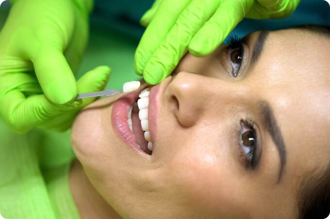 Bleaching (Zahnaufhellung) - Für wen ist ein Zahnbleaching geeignet?
