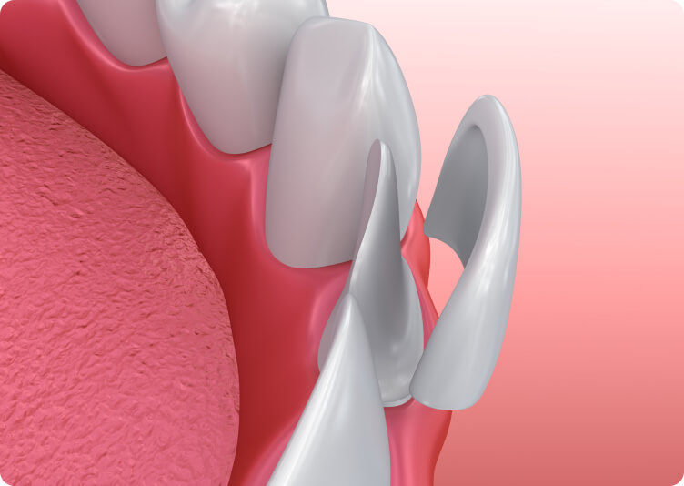 Cerec - Veneers