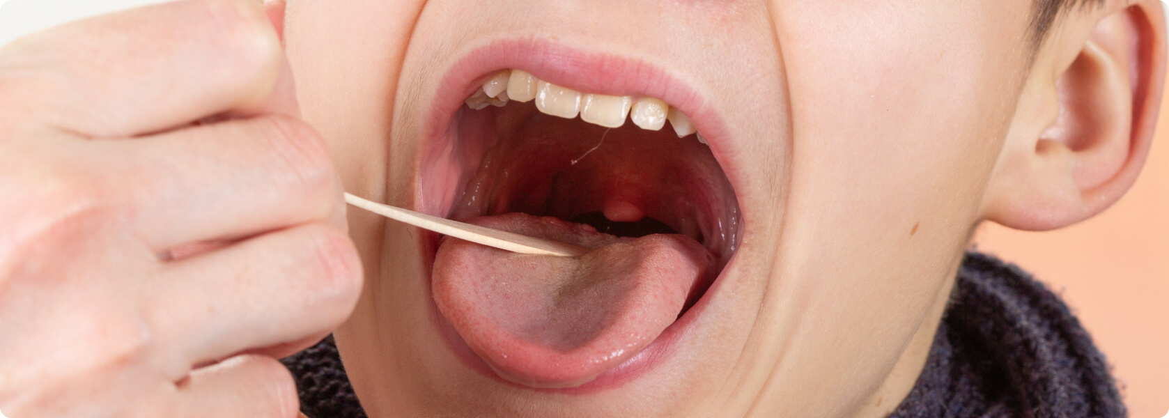 Mandelsteine (Tonsillensteine) - Helfen Antibiotika gegen Mandelsteine?