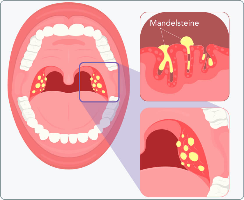 Mandelsteine (Tonsillensteine) - Sind Mandelsteine immer sichtbar?