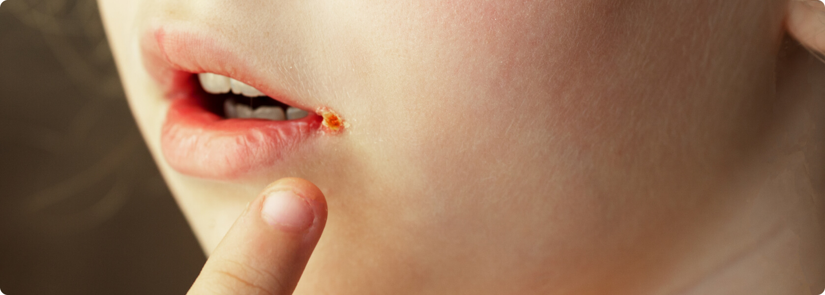 Mundfäule (Stomatitis) - Herpes