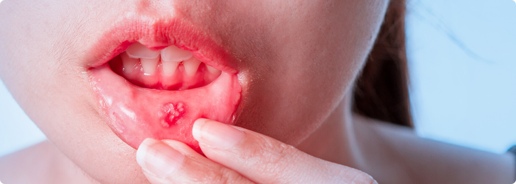 Mundfäule (Stomatitis) - Welche Ursachen hat eine Mundfäule?