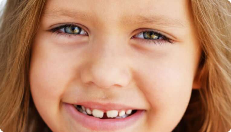 Zahnlücke (Diastema) - Wie entsteht eine Zahnlücke?
