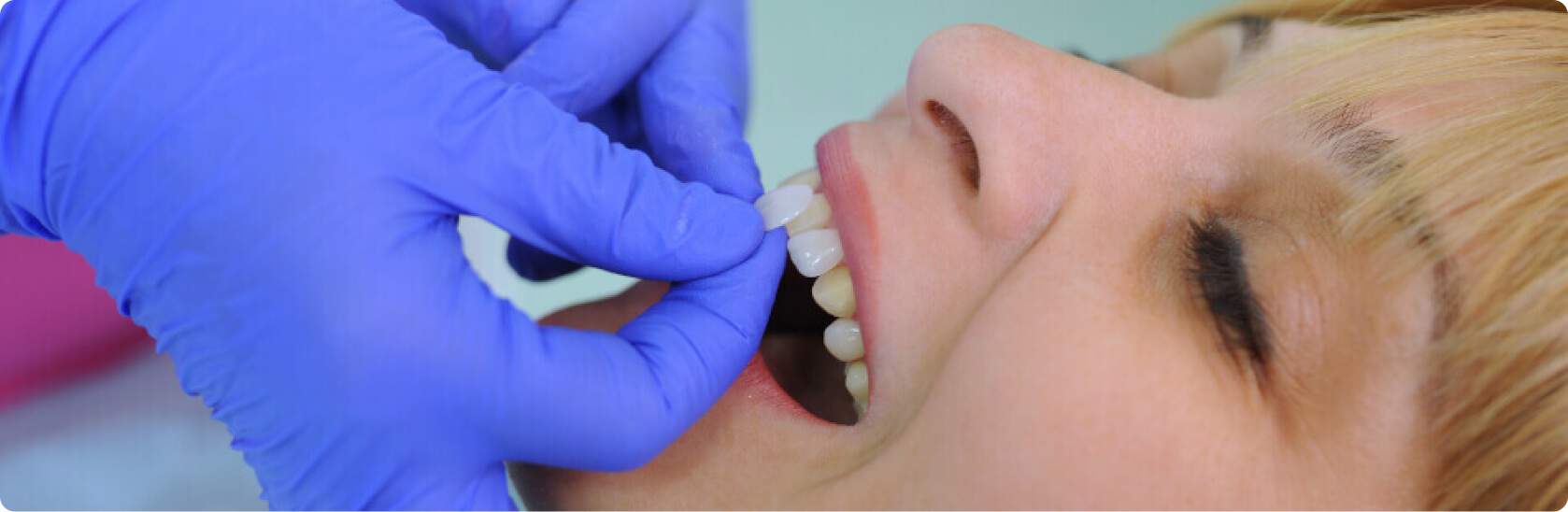 Veneers - Gibt es Alternativen zu Veneers?