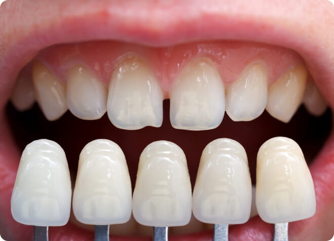 Veneers - Wann kommen Veneers zum Einsatz?