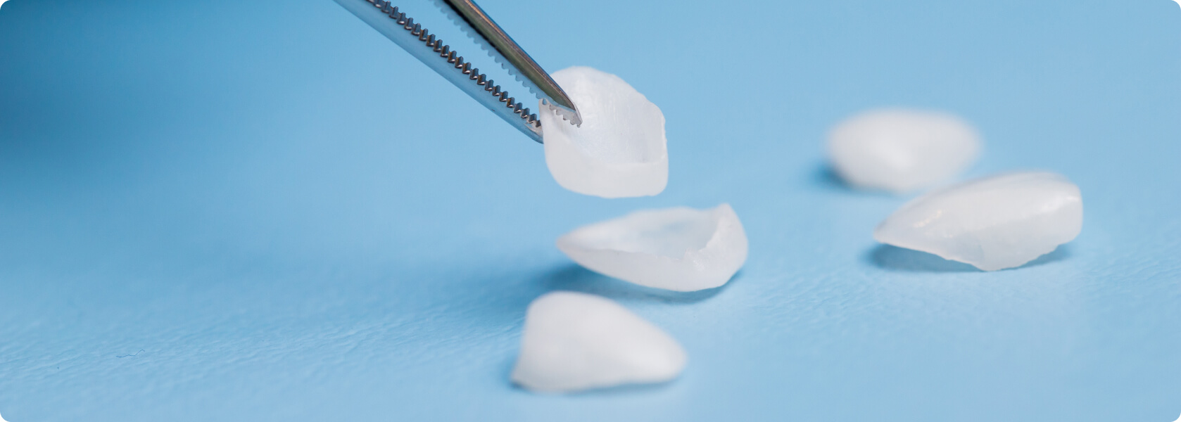 Veneers - Was sind Veneers?