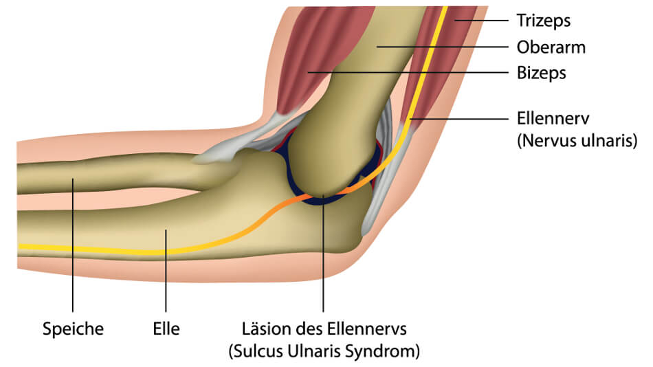 Ellenrinnensyndrom