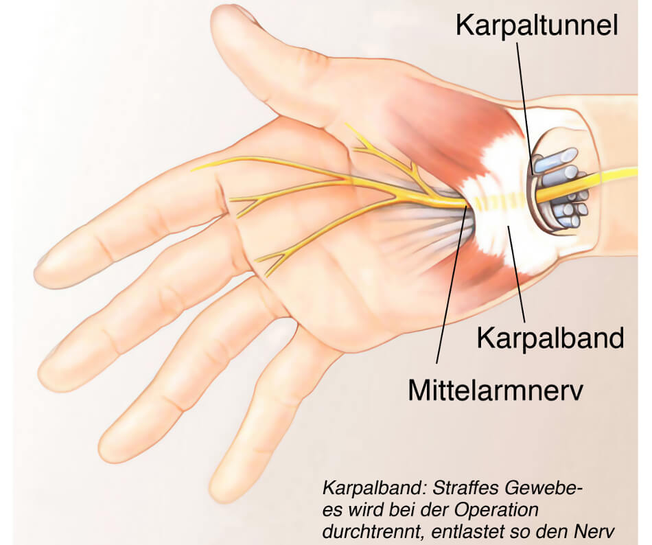 Karpaltunnelsyndrom