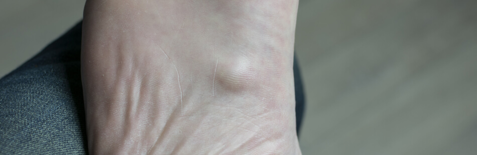 Fibromatose