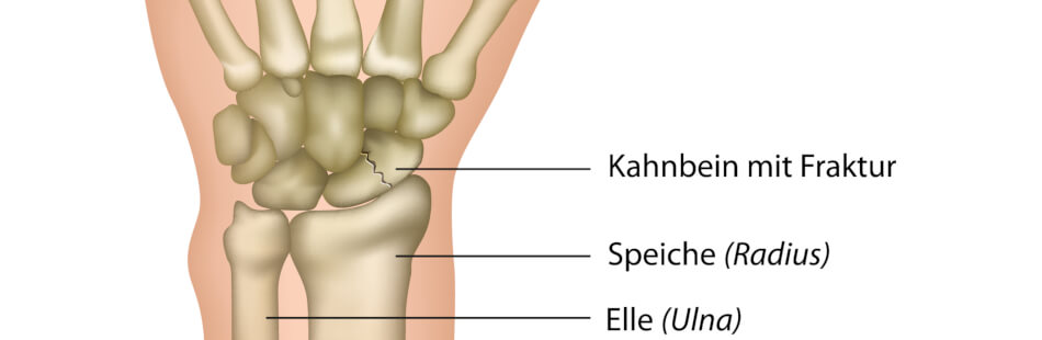 Kahnbeinbruch