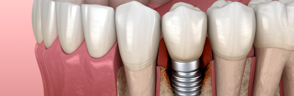 Periimplantitis