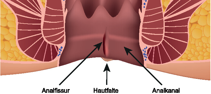 Analfissur
