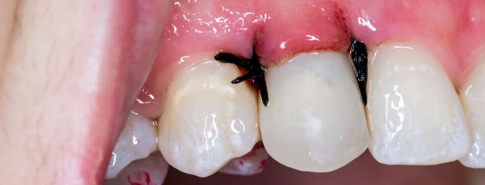 Zahntransplantation